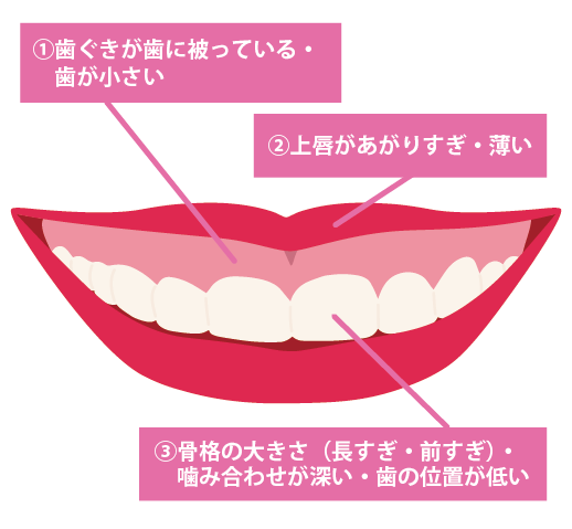 ガミースマイルになる3つの原因のイメージ図